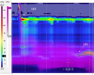 Dysmotility in Esophageal Atresia: Pathophysiology, Characterization, and Treatment